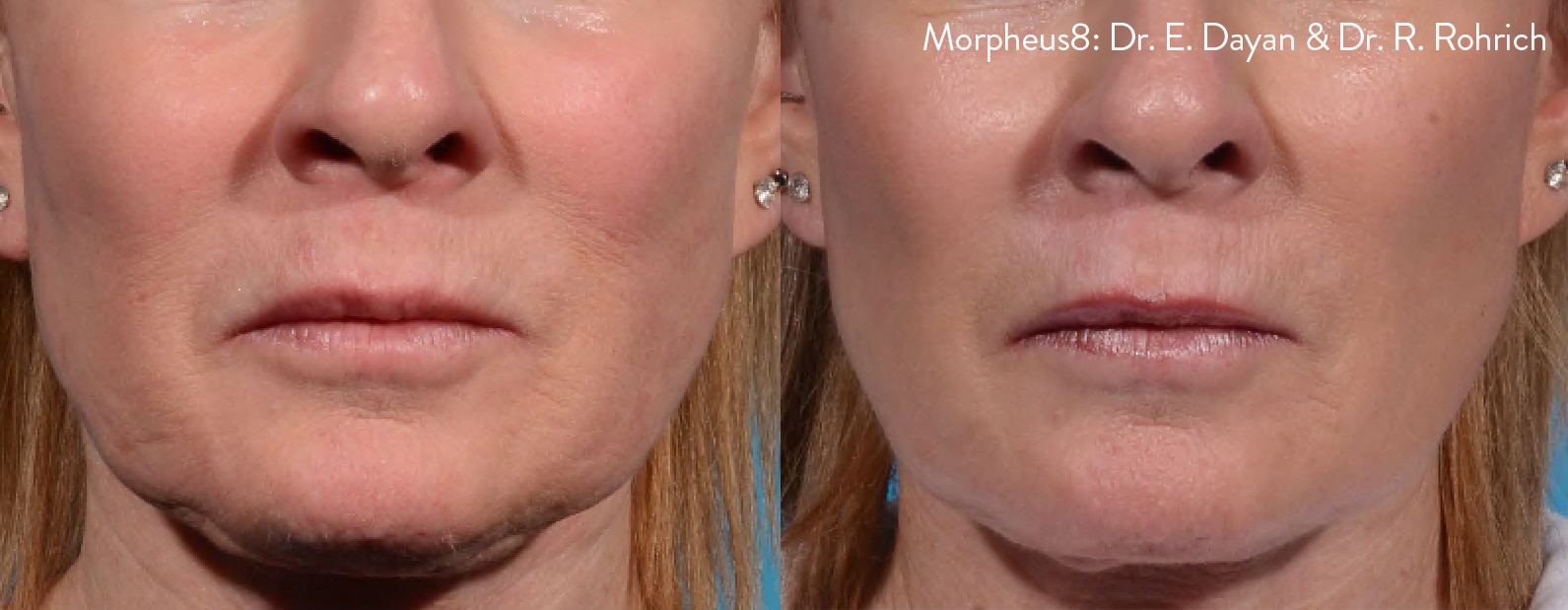 Facial Rejuvenation - Before and After