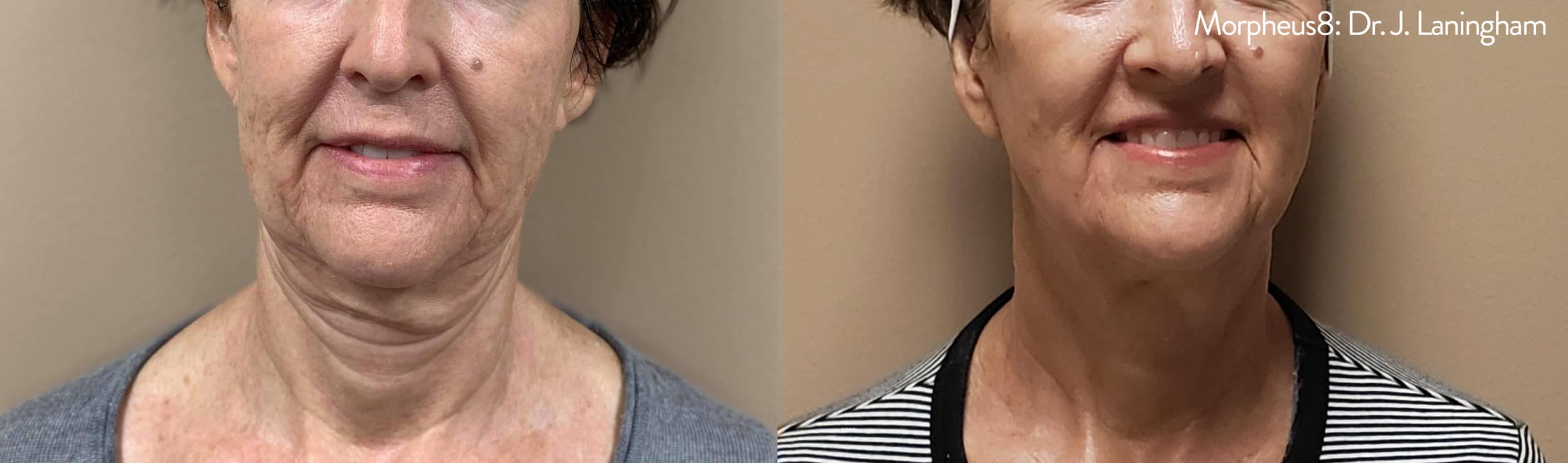 Facial Rejuvenation - Before and After